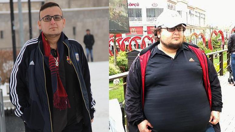 Tüp Mide Ameliyatı ile 109 kilo verdi